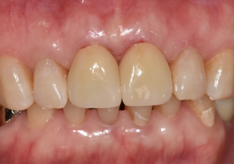 마모된 윗 앞니가 까맣게 변했다면? 방치하면 안 되는 이유 관련 이미지 10