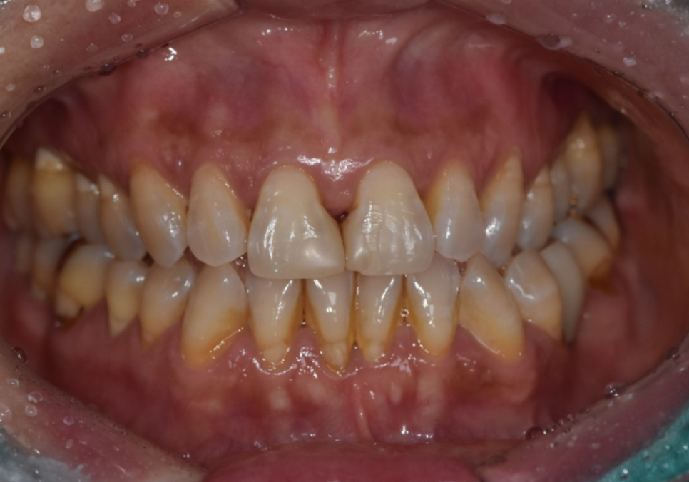고덕동 치과 누런 이, 앞니 사이 틈, 잘못된 관리 때문일까? 관련 이미지 1