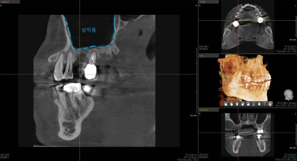 서울바르디치과 무절개 네비게이션 임플란트 치료증례 #8 관련 이미지 5