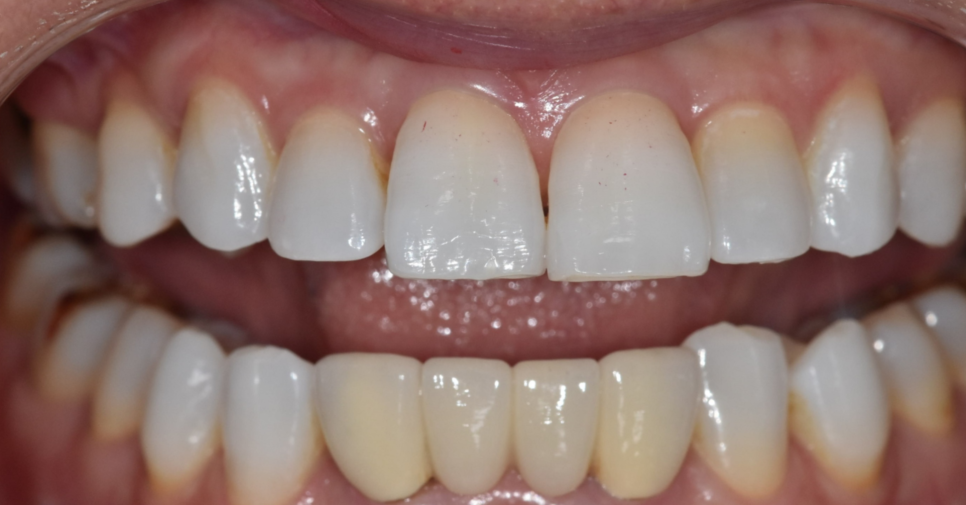 교정은 어릴 때 해야 한다? 성인과 청소년 교정, 뭐가 다를까? 관련 이미지 3