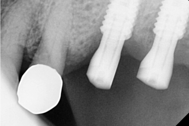 치아 크라운 빠짐 살릴 수 없을 때 강일역 임플란트 관련 이미지 8