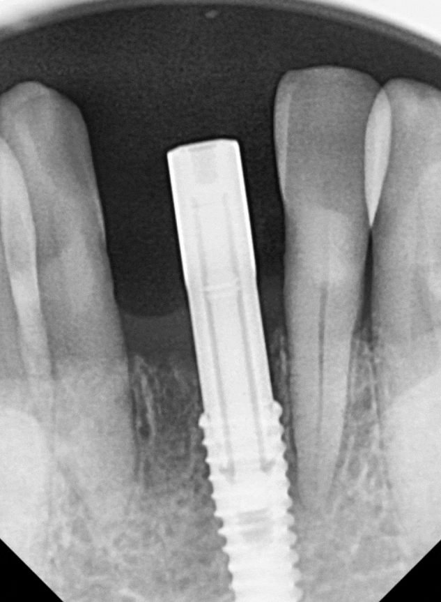 고덕동 아래 앞니 임플란트 비용 줄이는 비법, 공개합니다. 관련 이미지 8