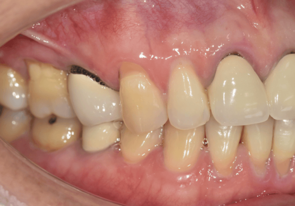잇몸 까매짐 원인,증상,치료 방법 오래전에 앞니 씌운 곳 잇몸이 까매졌어요. 관련 이미지 4