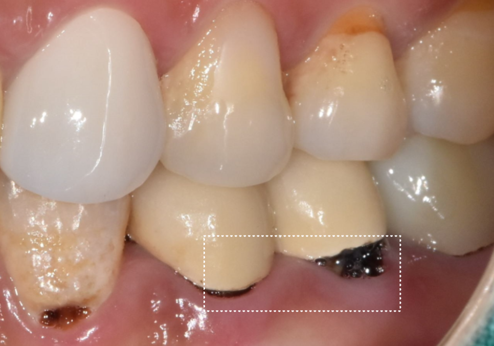 명일동 치과, 잇몸이 검게 변했다면? 앞니 변색 원인은 바로 관련 이미지 4