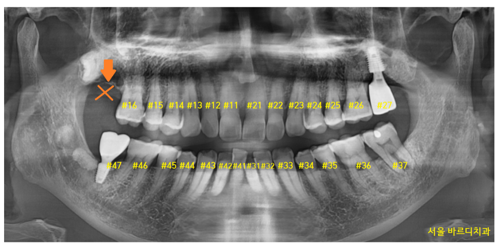 암사동 치과 임플란트 꼭 안 해도 되는 경우 궁금증 해결해 드려요 관련 이미지 3