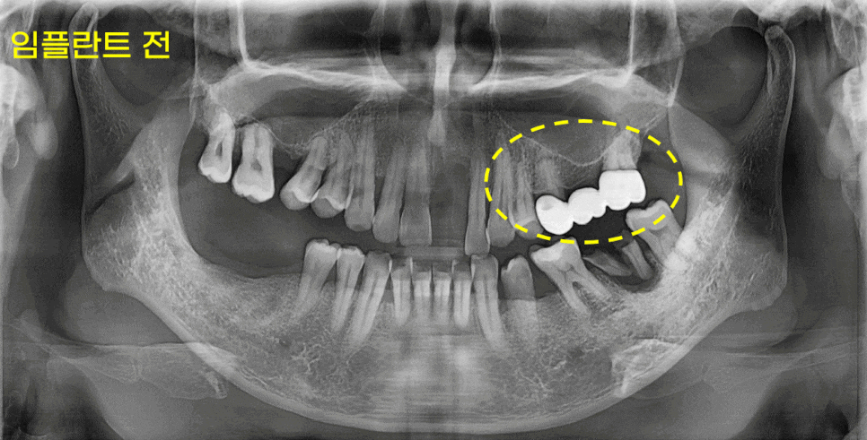 하남 임플란트 치과 하기 전에 확인해보면 좋을 2가지 관련 이미지 1