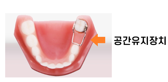 상일동 어린이치과 유치 곧 뽑을 치아이지만 치료가 필요한 이유 관련 이미지 1