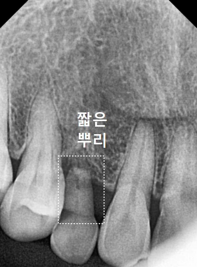 흔들리는 성인 잔존 유치, 50년 만에 송곳니 임플란트 하게 된 사연 관련 이미지 5