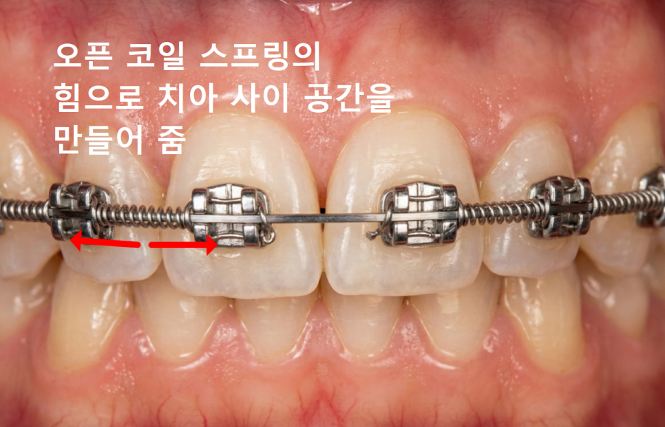명일역 앞니 부분 교정, 치아 하나만 삐뚤어져 보인다면? 굳이 전체 교정할 필요 없습니다. 관련 이미지 7