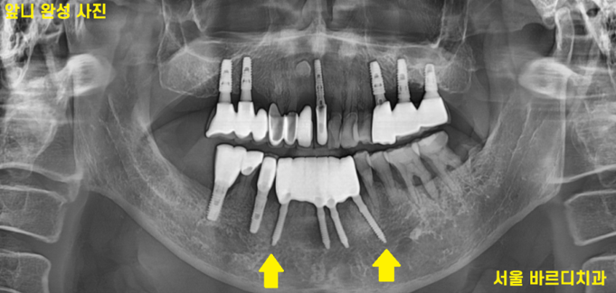 강동구 치과 앞니 흔들림 임플란트 케이스 관련 이미지 8