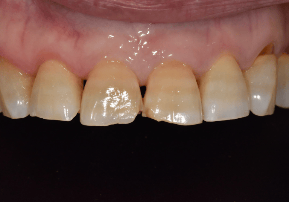 앞니 끝부분 깨짐, 다듬기, 레진, 라미네이트? 어떤 치료가 나에게 적합할까? 관련 이미지 4