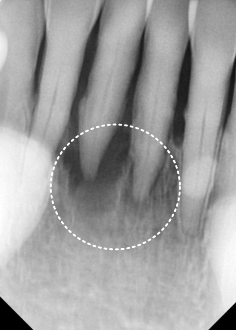 솟구치는 앞니, 흔들리는 치아가 보내는 관련 이미지 5