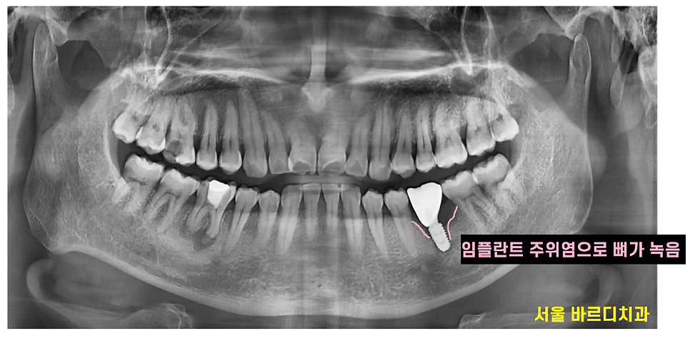 임플란트 잇몸 염증 주위염 증상이 늦게 나타납니다. 관련 이미지 4