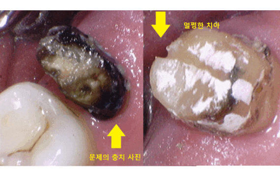 고덕역 근처 치과 브릿지와 임플란트 고민 중이신 분들 클릭하세요 관련 이미지 1