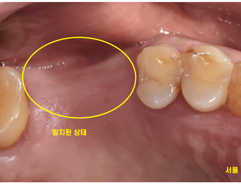 강일동 치과 전남 완도에서 올라오셔서 발치 후 당일 임플란트 완료하였습니다. 관련 이미지 1