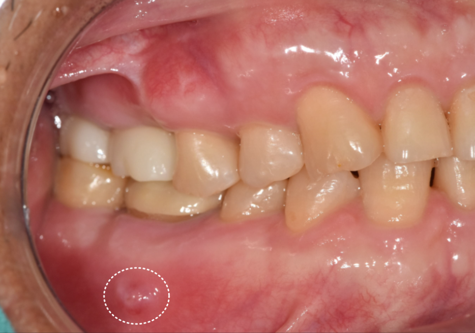 강동구 잇몸 여드름, 이런 상태라면 절대 겉에만 짜는 치료 하지 마세요. 관련 이미지 2
