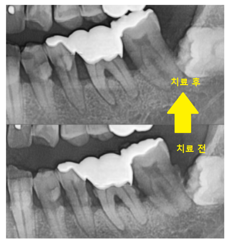 잇몸 곪음 피가 나오고 치통이 있을 때 관련 이미지 4