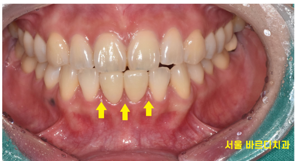 벌어진 아래 앞니 라미네이트로 감쪽같게 치료했습니다. 관련 이미지 7