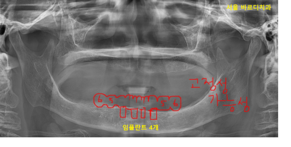 상일동 근처 치과 얇은뼈 틀니 안될 때 해결 방법은?? 관련 이미지 6
