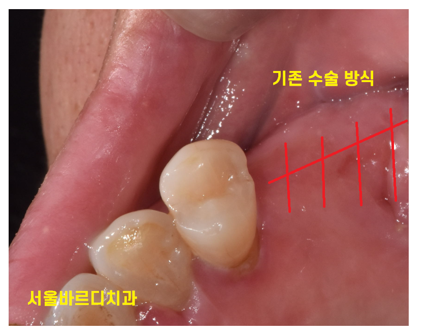 고덕동 임플란트 통증 걱정으로 수술 엄두가 안나시는 분들께 관련 이미지 3