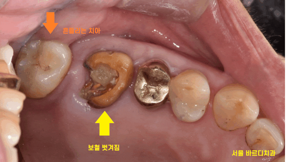 고덕동 치과 임플란트 거부감이 있었지만 네비게이션 수술법으로 해결했습니다. 관련 이미지 1