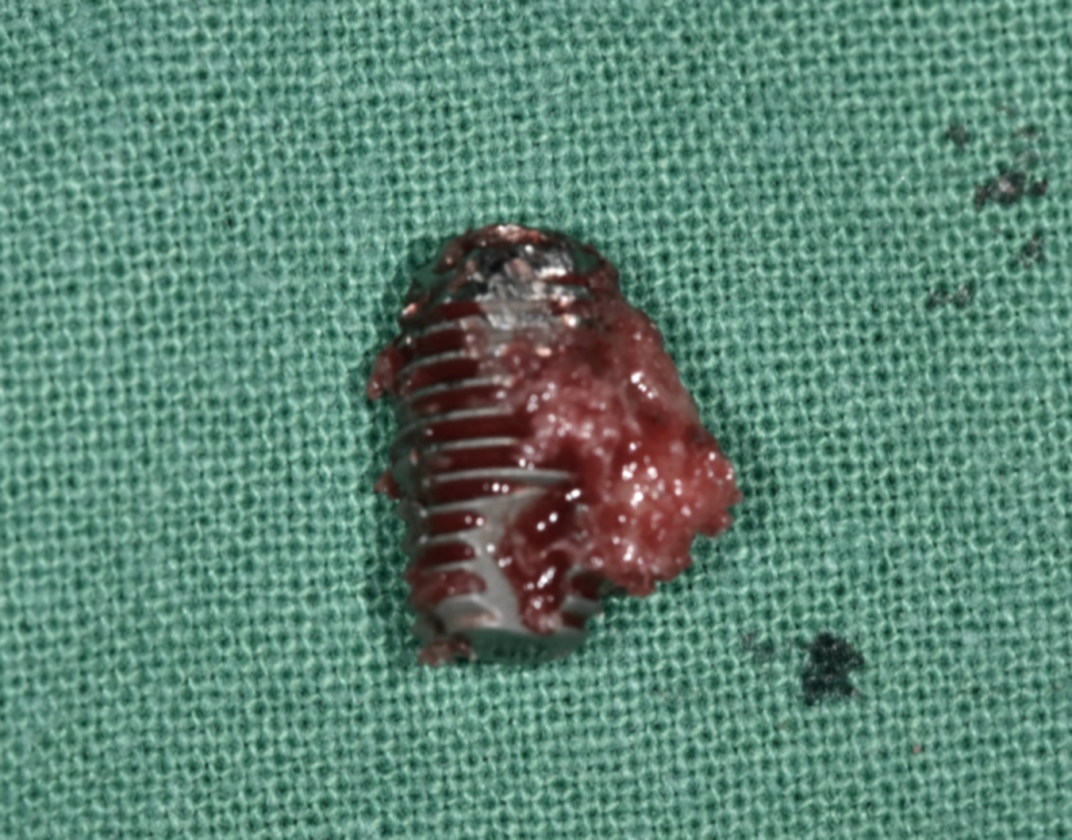 임플란트 충치 걱정? 잇몸을 먼저 생각하세요 관련 이미지 4