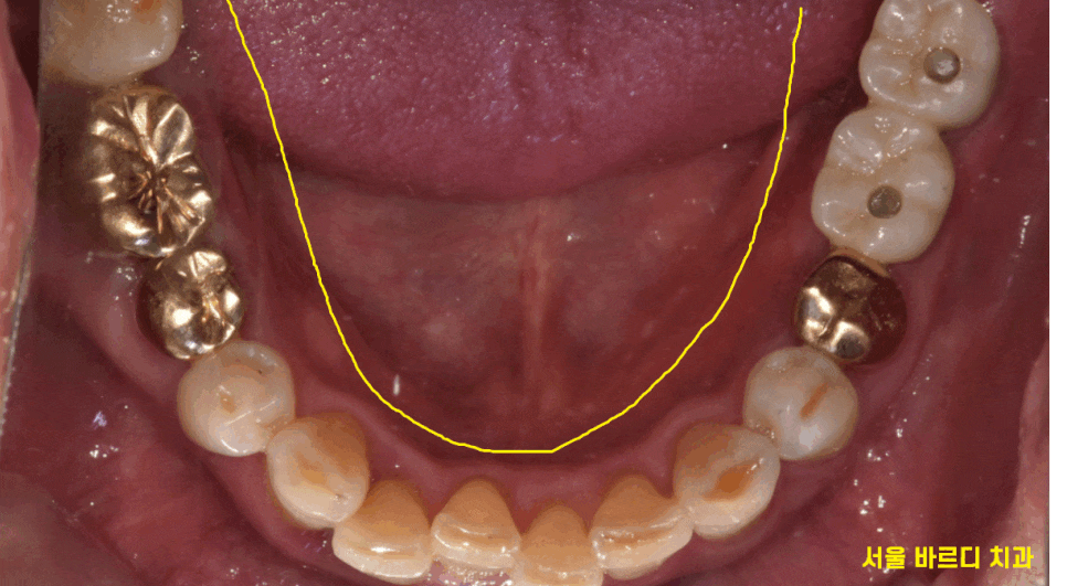 고덕동 치과 디지털 임플란트는 뭔가요? 뭐가 달라요? 관련 이미지 1