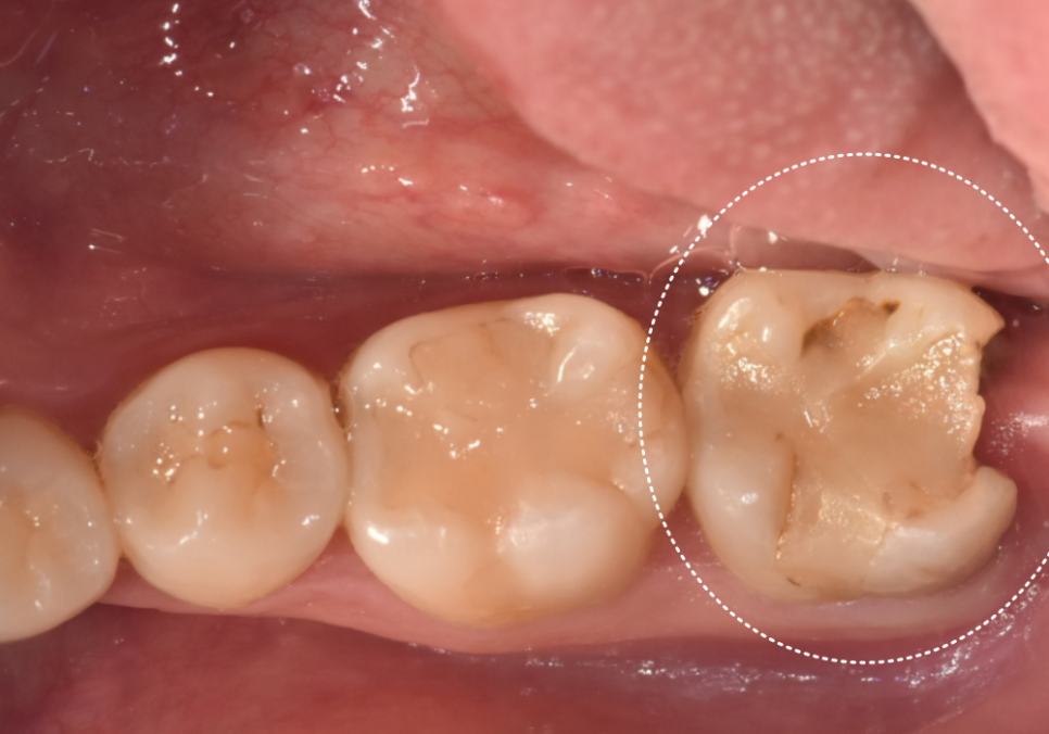 If you lightly brush your backmost molar because the toothbrush can’t reach it, this is what happens. image 3