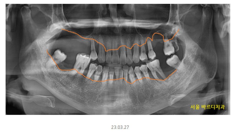 길동 치과 임플란트 뼈이식 흡연 관련 있을까? 관련 이미지 2