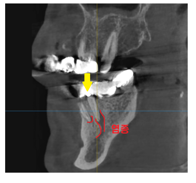강일동 임플란트 씌운 치아 통증 불편할 때는 치과를 방문해주세요 관련 이미지 5