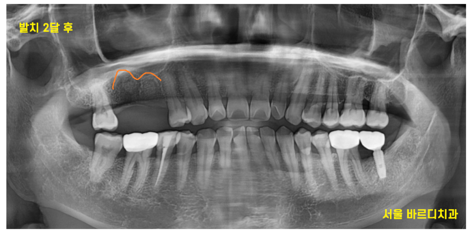 고덕역 임플란트 잇몸 뾰루지 뼈이식 두번 하여 해결했습니다. 관련 이미지 7