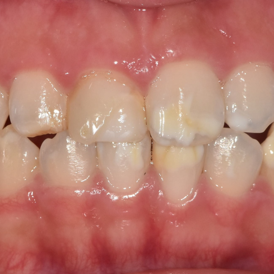 강동구 라미네이트, 치아 하얀 반점 없애고 싶다면? 치료 방법 관련 이미지 1