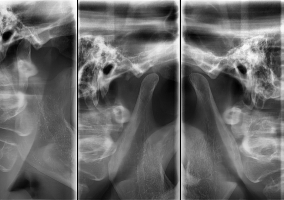 Myeongil-dong Implant Treatment in Your 20s: The Reason It Ended Up Requiring Bone Grafting After Thinking, “I’m Young, So It’ll Be Fine” image 5