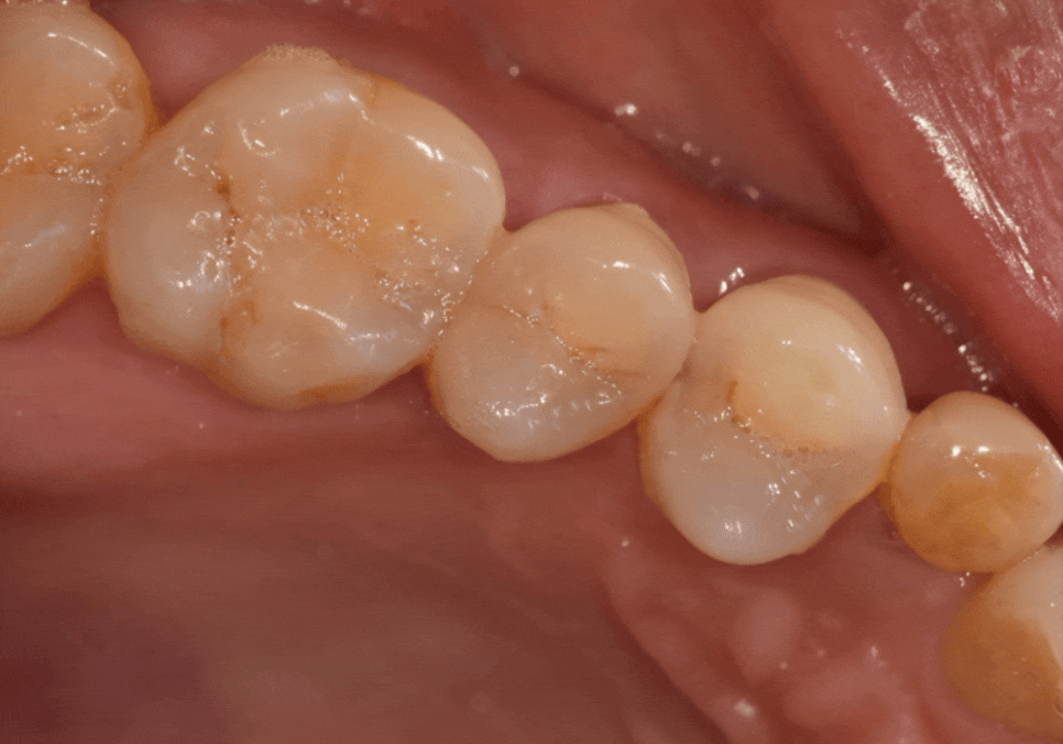 흔들리는 성인 잔존 유치, 50년 만에 송곳니 임플란트 하게 된 사연 관련 이미지 4