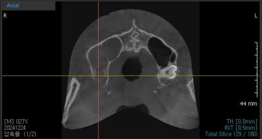 상악동염 이비인후과 치료 후 임플란트를 해야할 수 있습니다. 관련 이미지 2