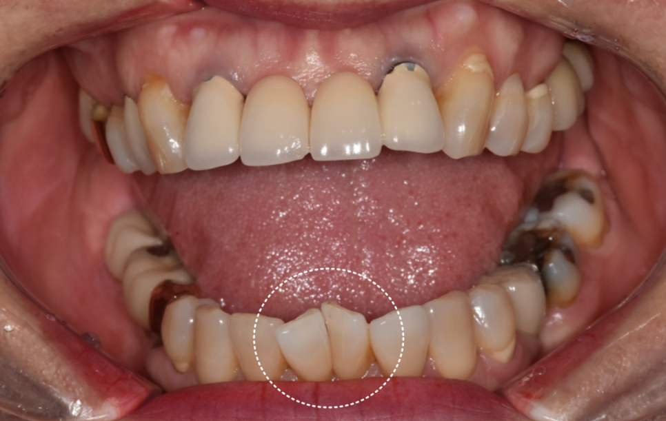 명일동 앞니 브릿지, 새로 교체 할 때 꼭 확인해 봐야 할 관련 이미지 7