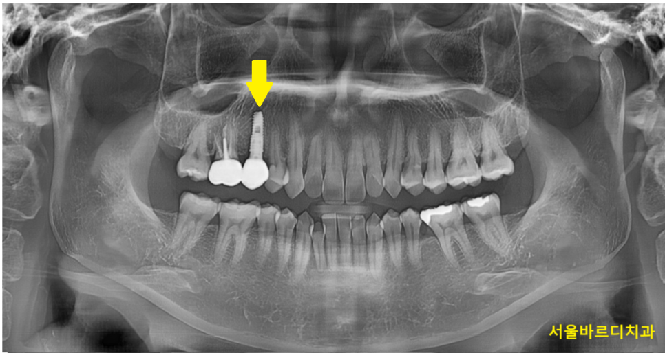 씌운 치아 부러짐 뿌리만 남은 경우 임플란트로 수복하기 관련 이미지 8