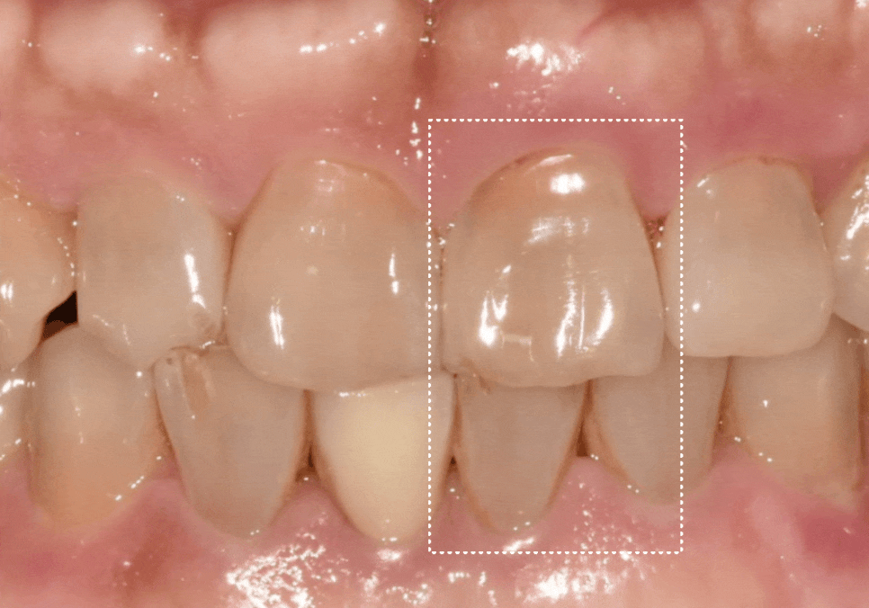 앞니 깨짐 치료 비용, 더이상 치과에 돈 낭비하기 싫다면? 깨지는 원인부터 알아야 합니다. 관련 이미지 14