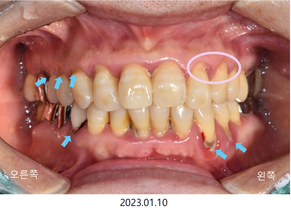 고덕동치과 서울바르디치과 무절개 네비게이션 임플란트 치료증례 #2 관련 이미지 2