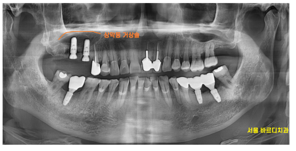 상일동 임플란트 치아 솟음으로 불편함을 느낄 때 관련 이미지 6