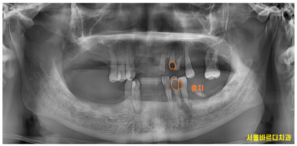 앞니 어금니 임플란트 동시에 진행할때 순서는? 관련 이미지 2