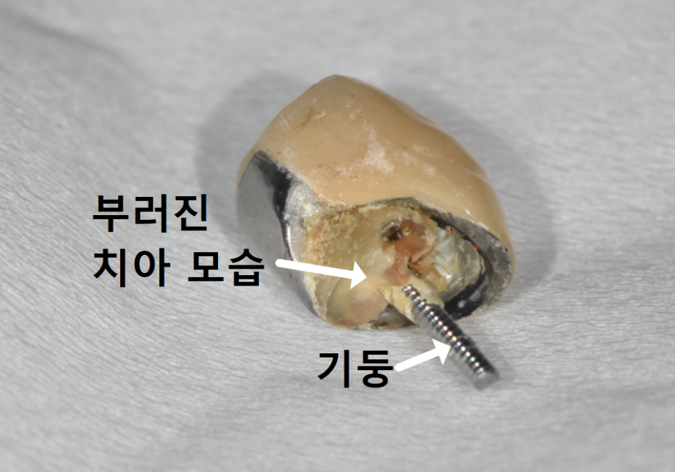 Godeok-dong Tooth Fracture: Check This Before Getting an Implant! Revealing the Criteria for Saving It image 10