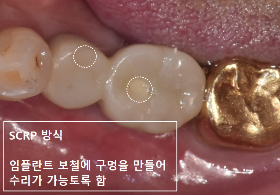 상일역 임플란트, 음식물 끼는 이유, 처음엔 안 그랬는데 왜 점점 심해지는 걸까요? 관련 이미지 13