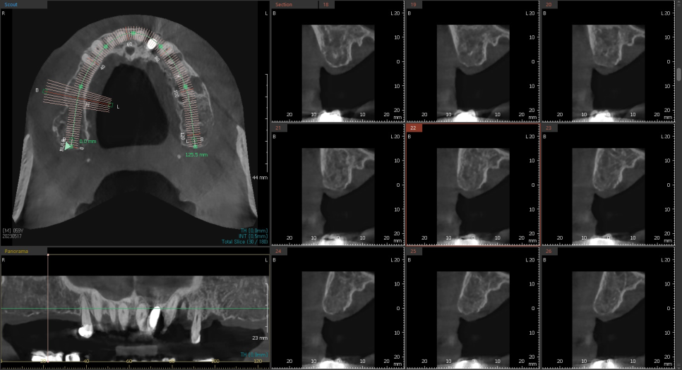 오늘 임플란트 심고, 내일 씹는게 가능하다고요?? (잔존골은 정답을 알고있다) 관련 이미지 3