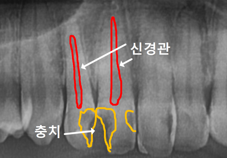 A Single Black Spot of Decay Between the Front Teeth May Be a Warning Sign of Multiple Cavities. image 6