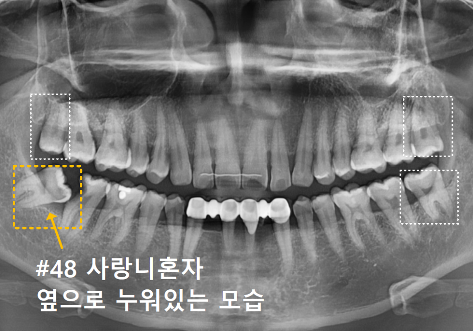 수평 매복 사랑니, 옆으로 누운 사랑니 때문에 멀쩡한 어금니까지 뽑은 사연 관련 이미지 3