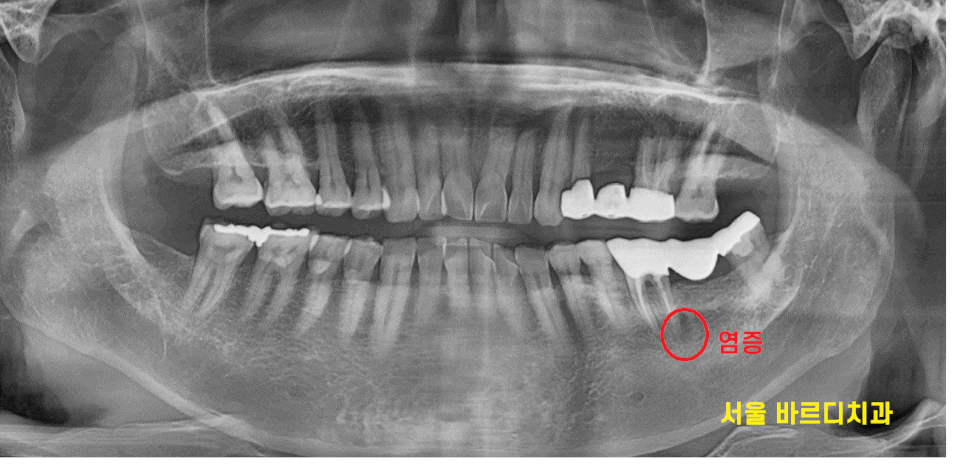 강일동 임플란트 씌운 치아 통증 불편할 때는 치과를 방문해주세요 관련 이미지 1