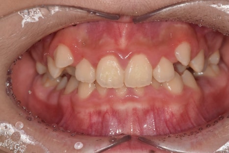 When Should My Child Start Orthodontic Treatment? When to Begin Now vs. When It Is Fine to Wait image 3