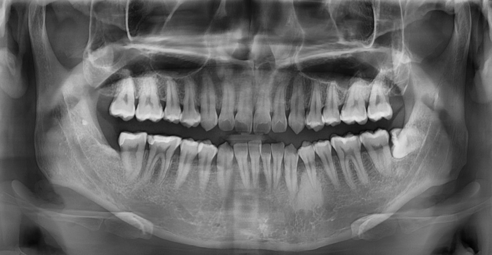 매복 사랑니 발치 후 냄새 드라이소켓 증상일 수 있습니다 . 관련 이미지 5