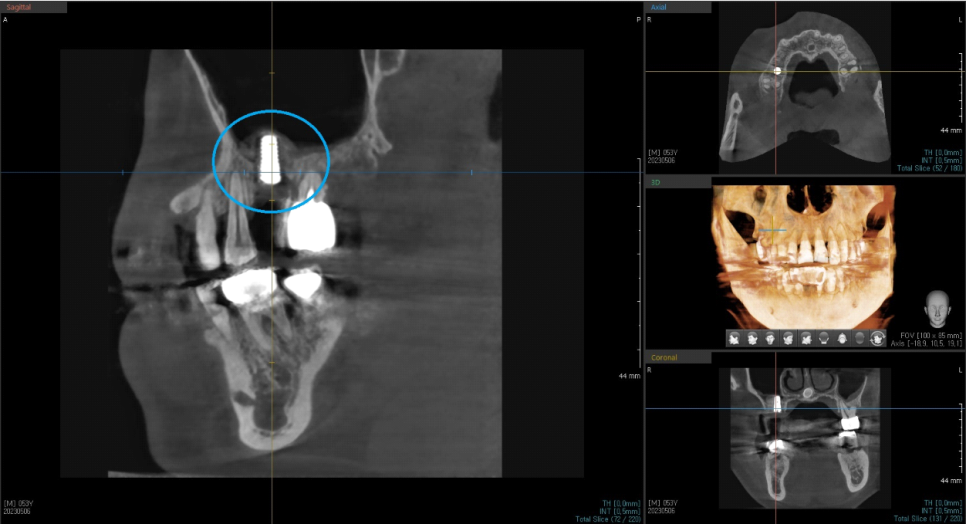 서울바르디치과 무절개 네비게이션 임플란트 치료증례 #8 관련 이미지 6